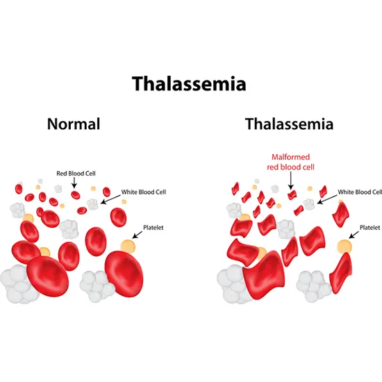 Thalassemia Syndrome: Types, Causes, Symptoms & Treatment